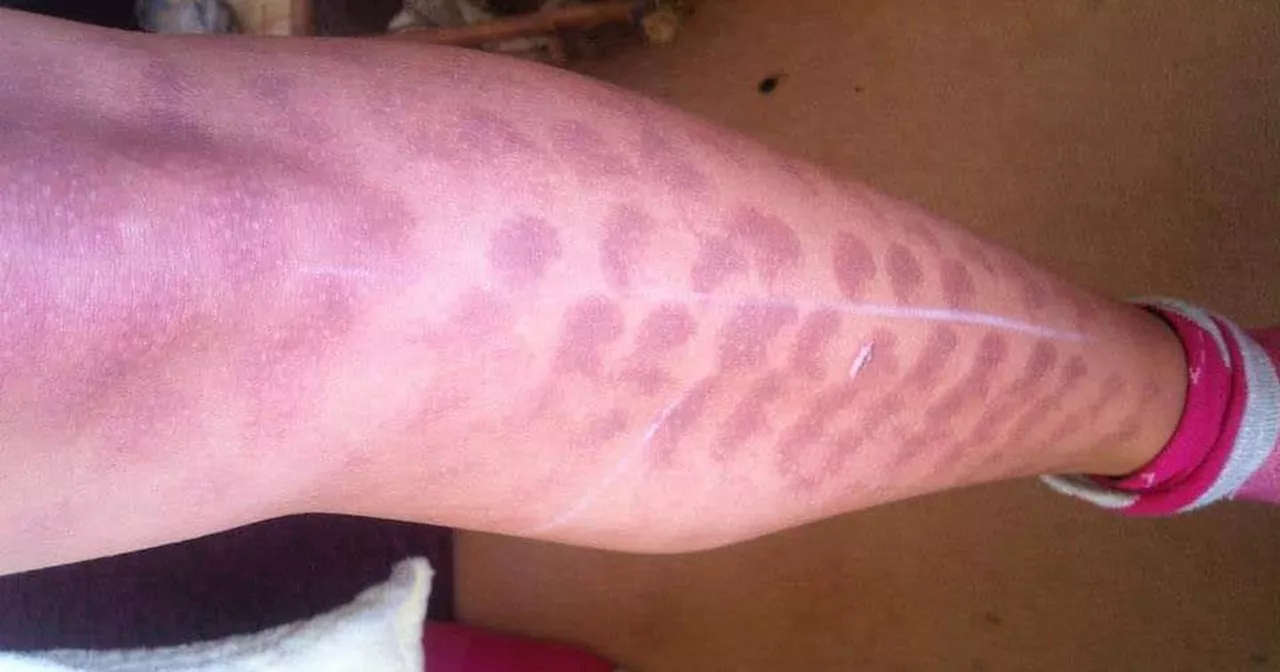 Woman settles case alleging burns from laser hair removal that left her looking ‘like a leopard’