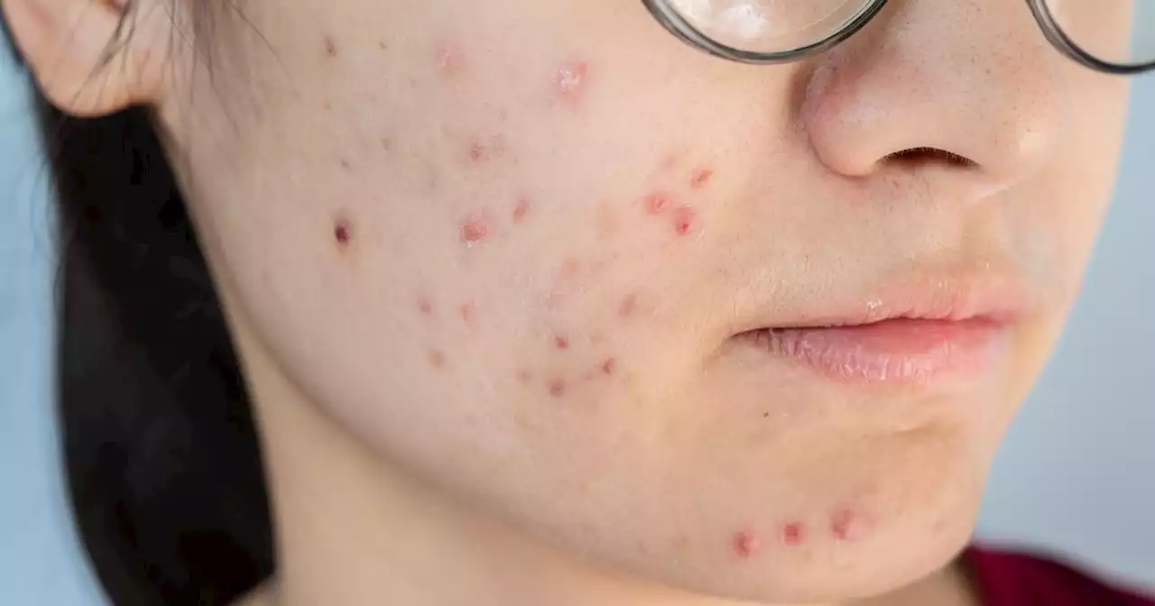 Health experts share what foods are bad for your skin and how they cause acne