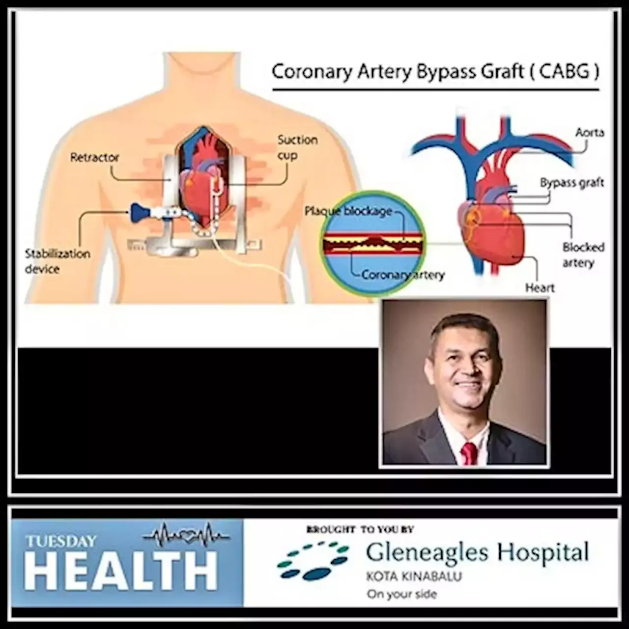 Coronary Artery Bypass Grafting: Safe and effective