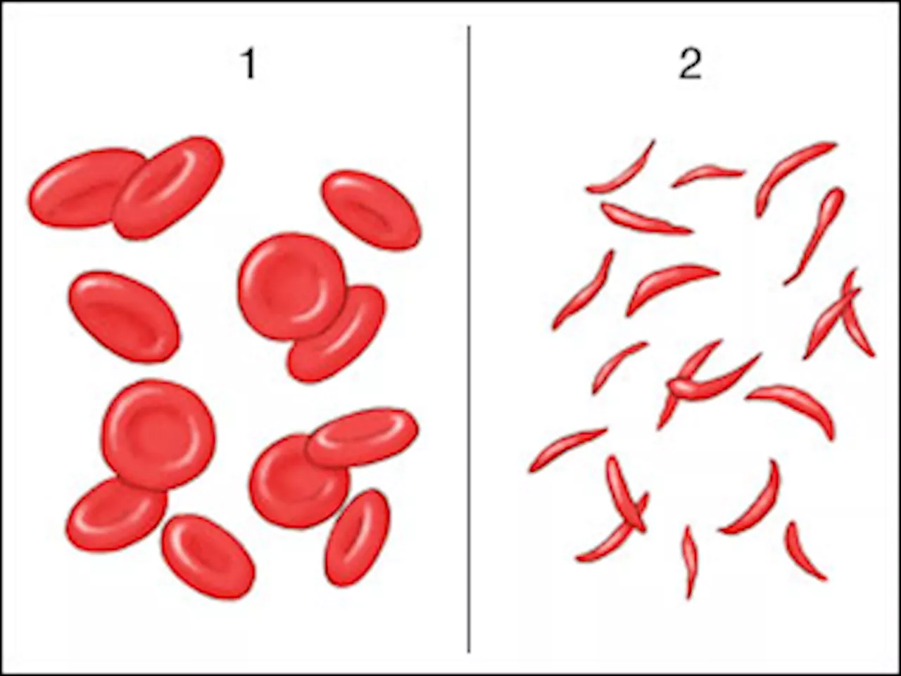 A new cure for sickle cell disease may be coming. Health advisers will review it