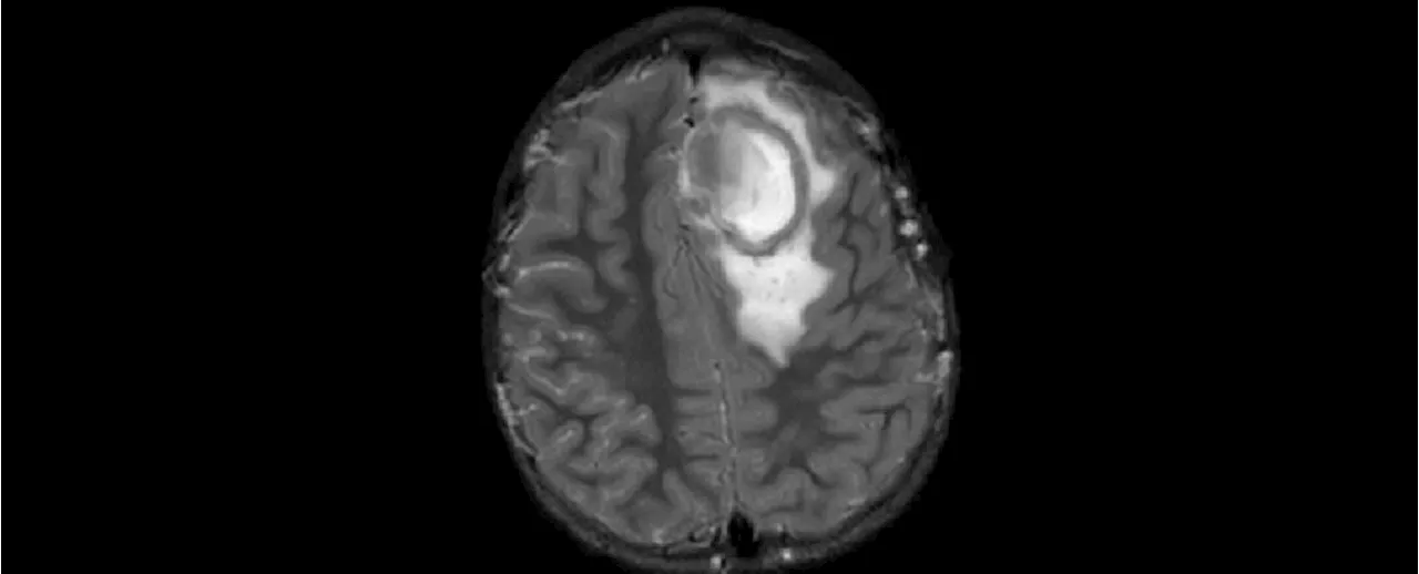 Abnormal Surge of Brain Abscesses in American Children, CDC Reports