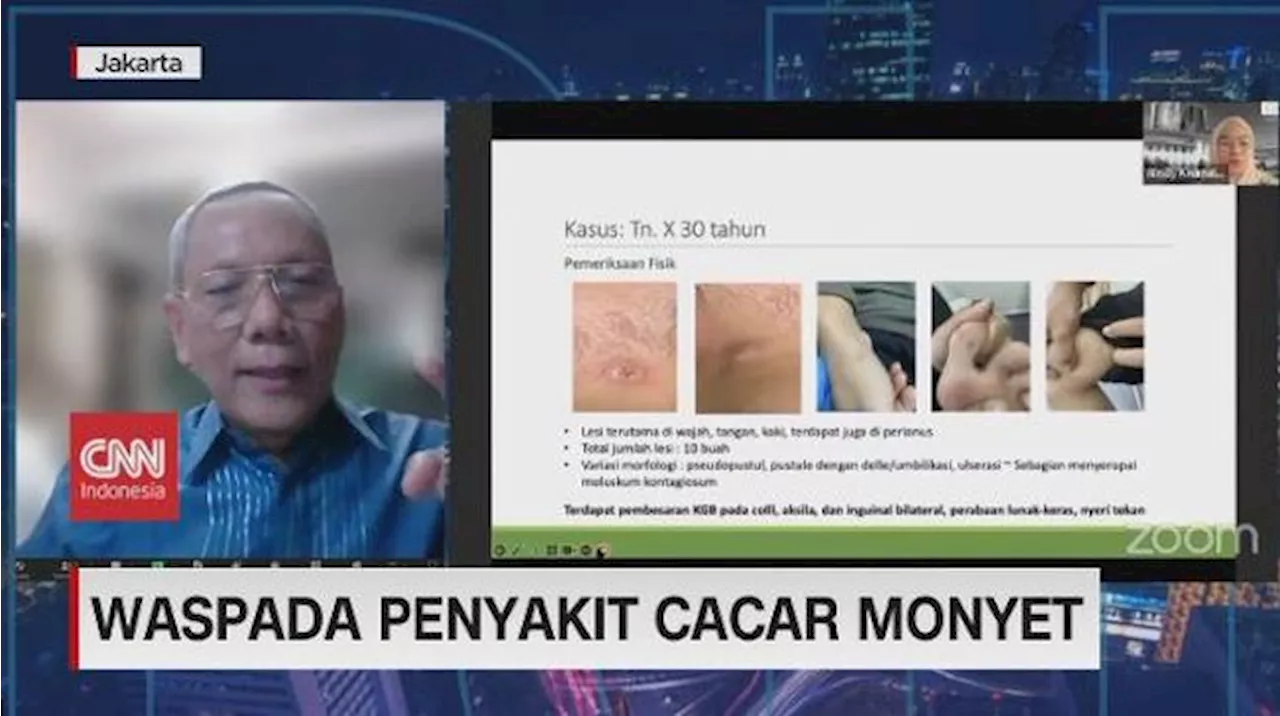 VIDEO: Waspada Penyakit Cacar Monyet