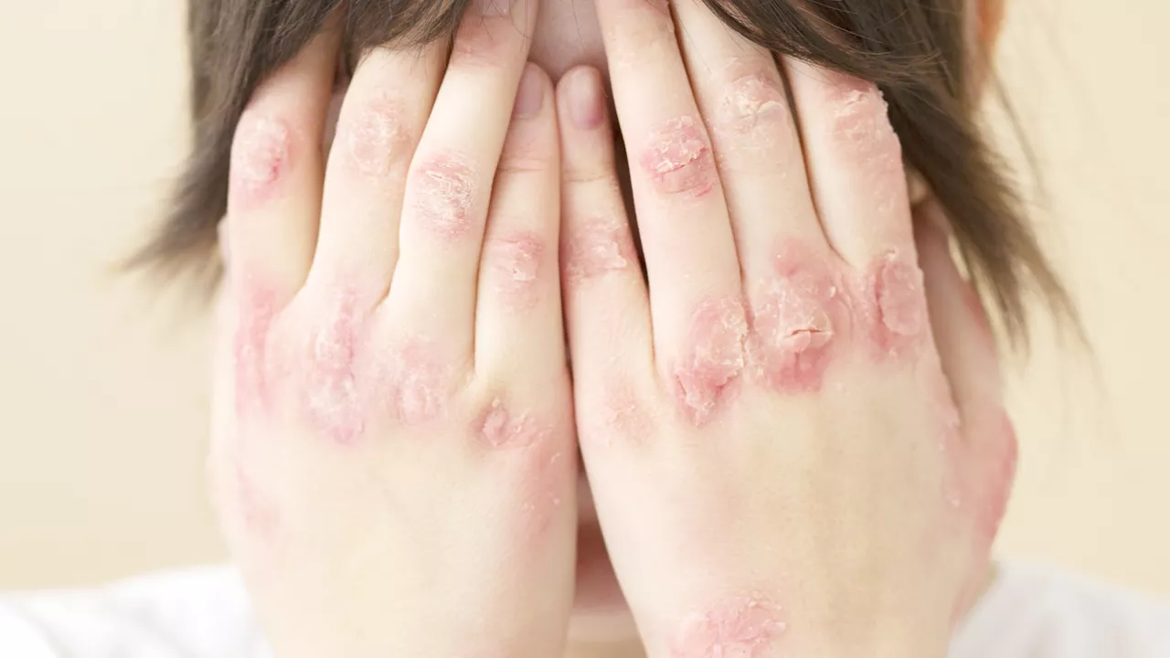 What can I do to prevent skin flare ups?