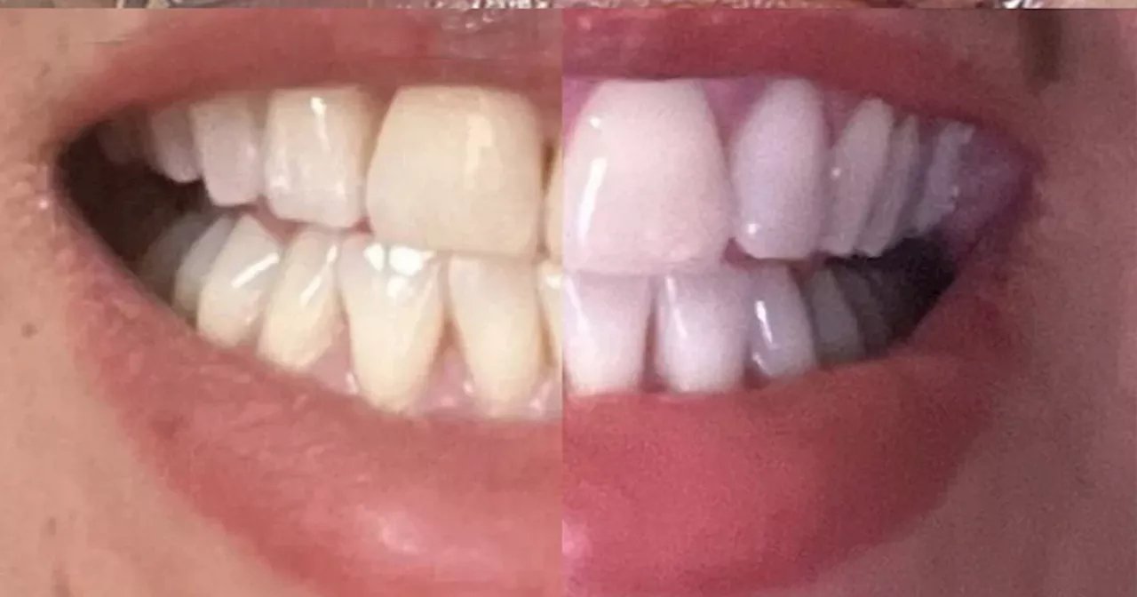 Amazon Customers Rave About Budget-Friendly Teeth Whitening Solution