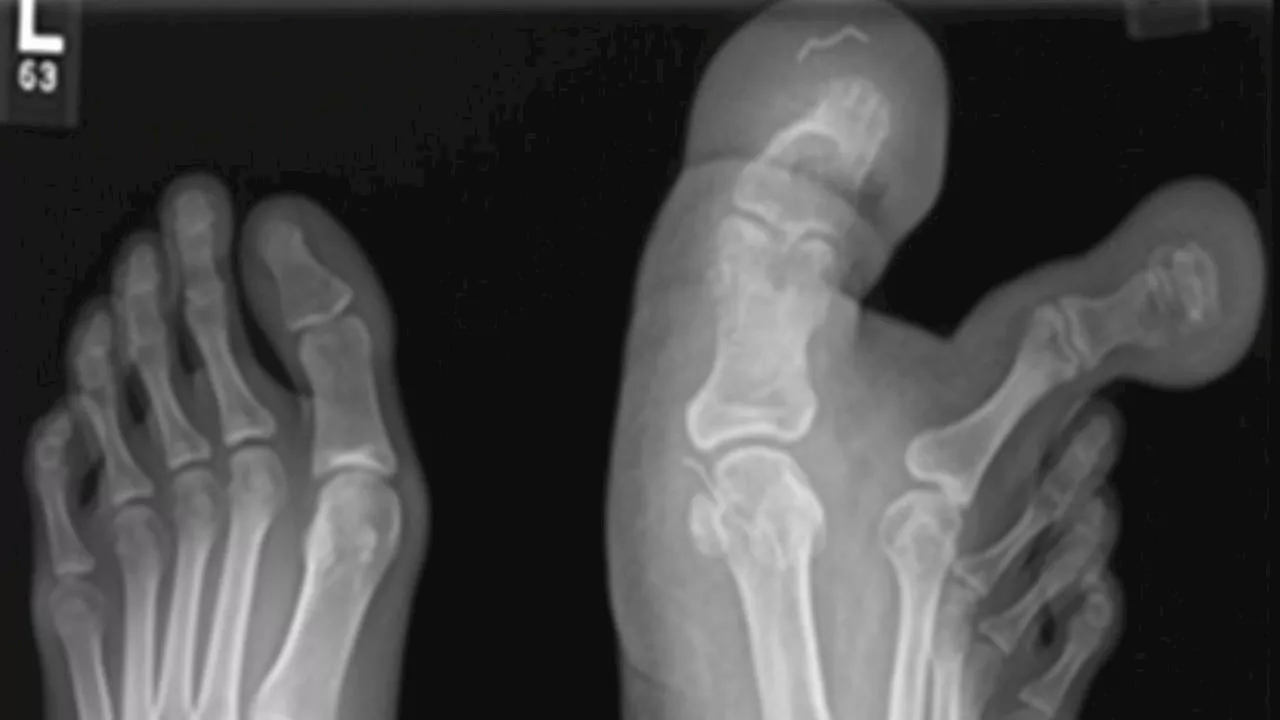 Xray reveals why 12yo couldn’t wear shoes