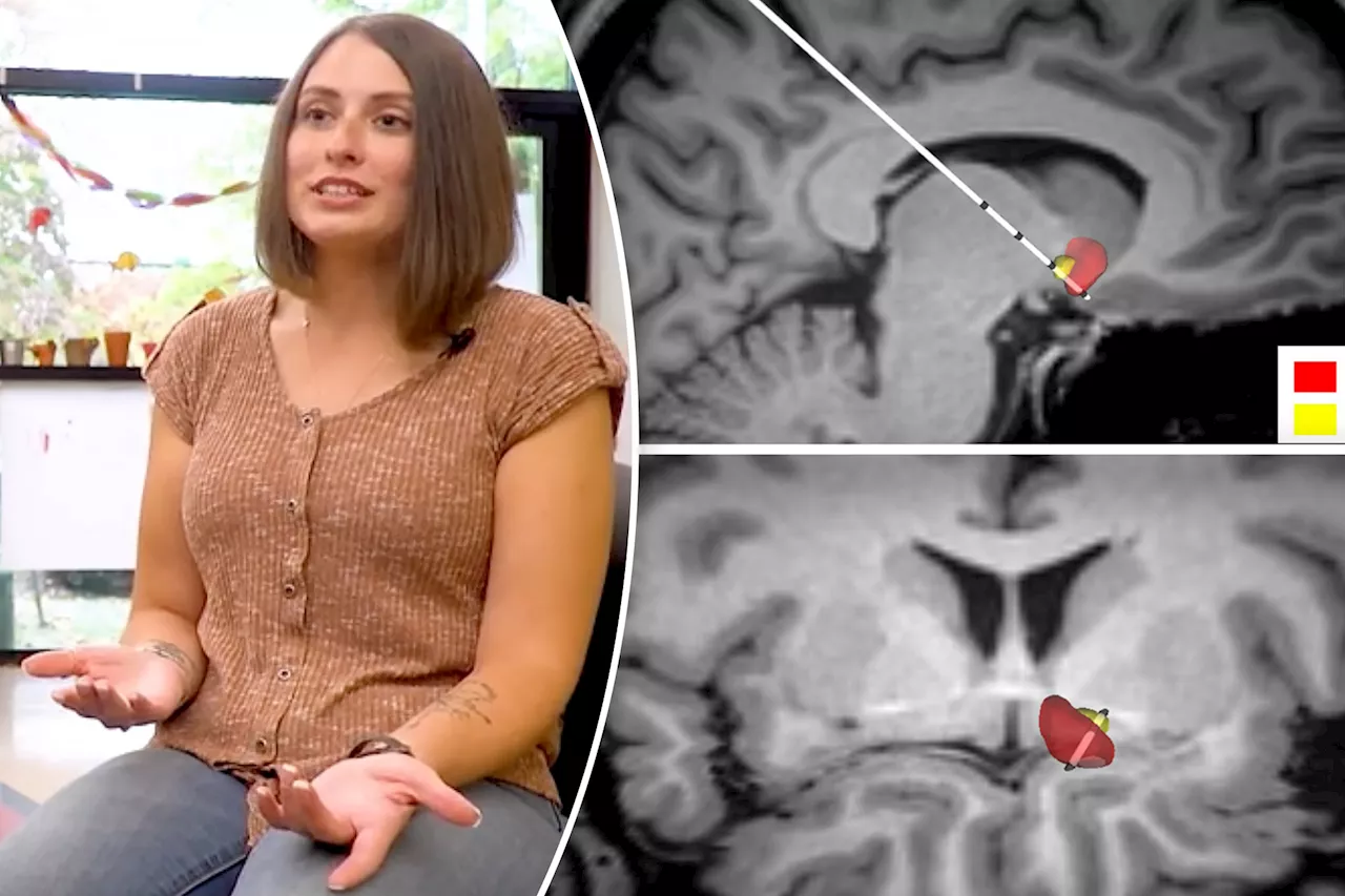 Patient's OCD, epilepsy curbed with electrical brain implant: 'This is pretty remarkable'