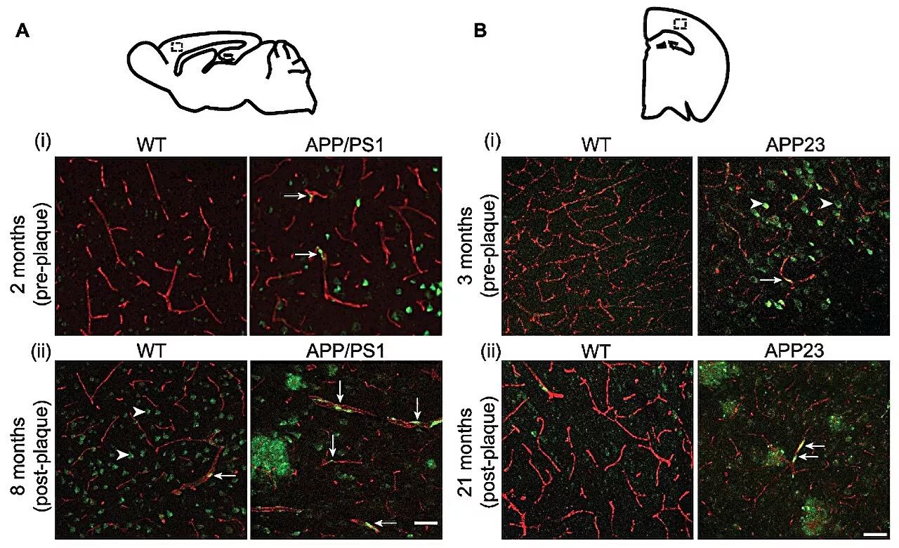 Blood vessel breakdown linked with Alzheimer's disease