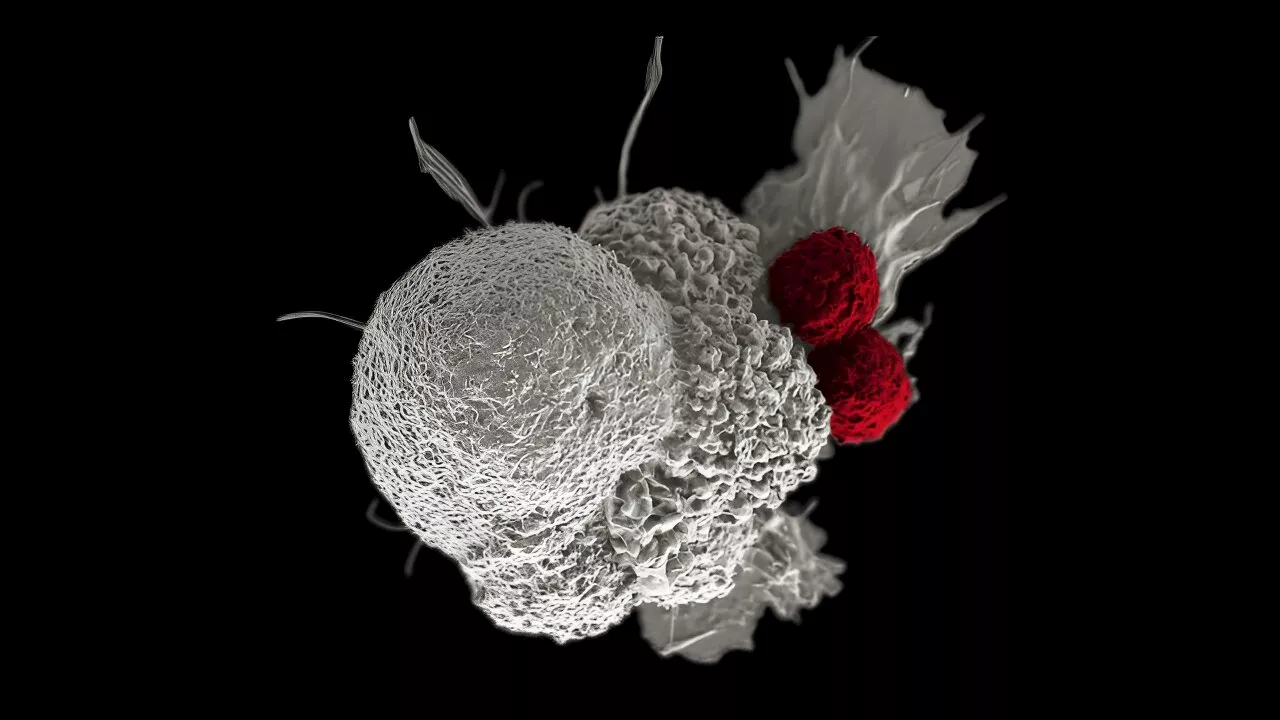 Immunotherapy shows promise as a kinder first-line treatment for advanced head and neck cancers