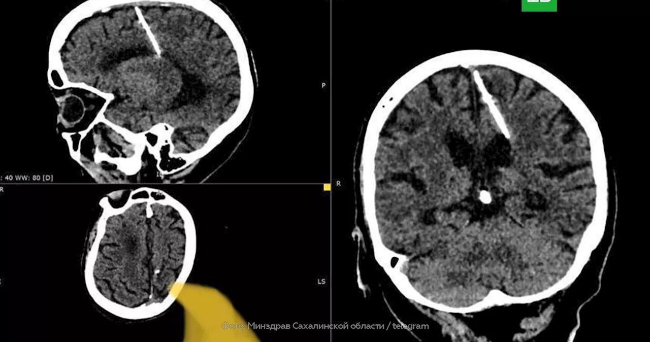 На Сахалине женщина 80 лет прожила с трехсантиметровой иглой в мозге