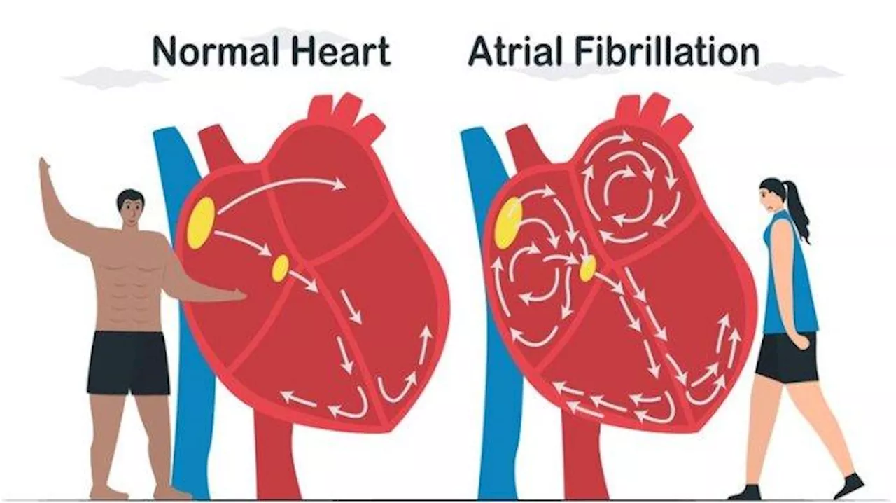 Atrial Fibrilasi Dapat Tingkatkan Risiko Penyakit Stroke dan Gagal Jantung, Begini Penjelasan Dokter