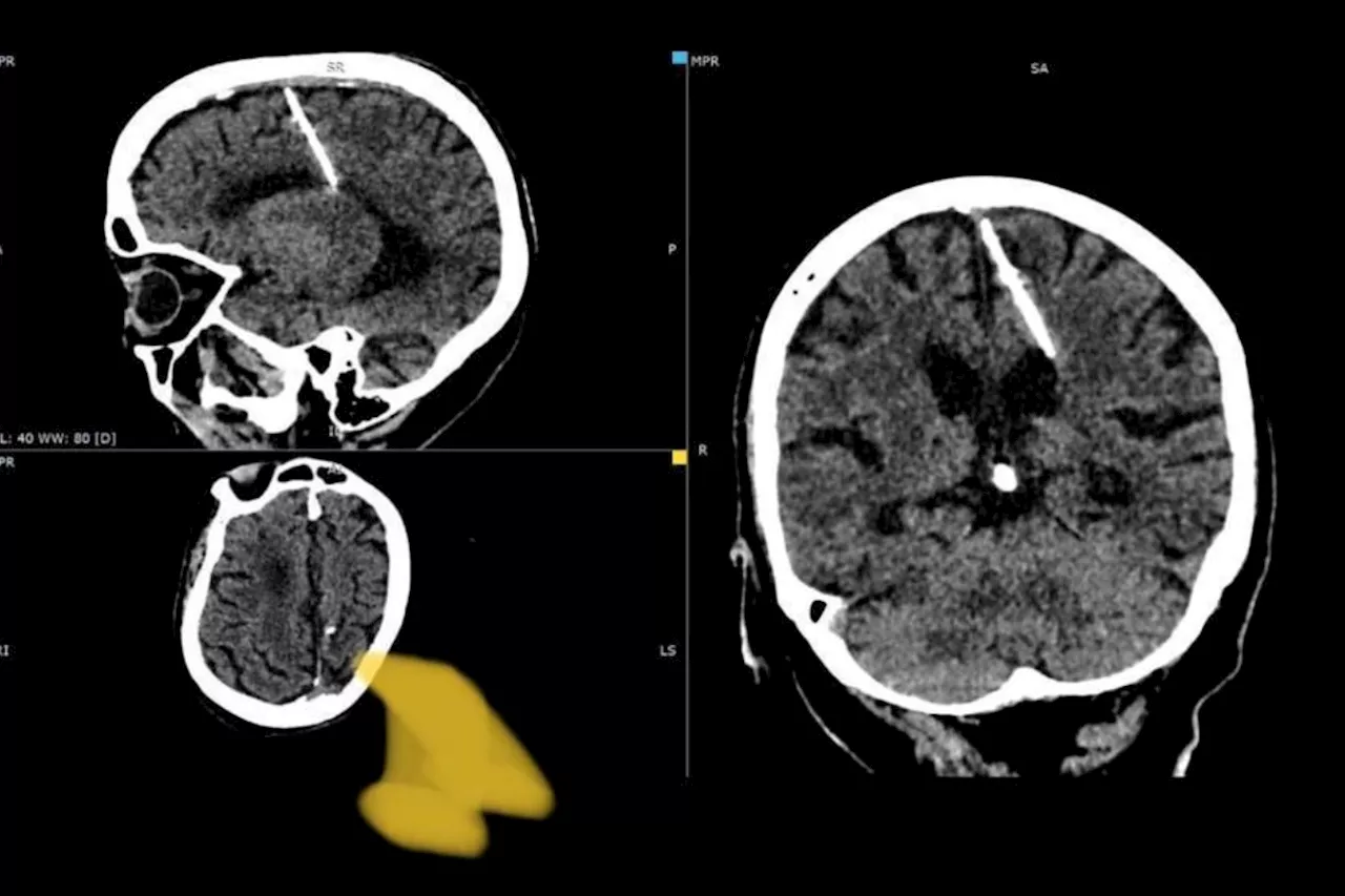 Russian doctors discover needle in woman’s brain in Sakhalin