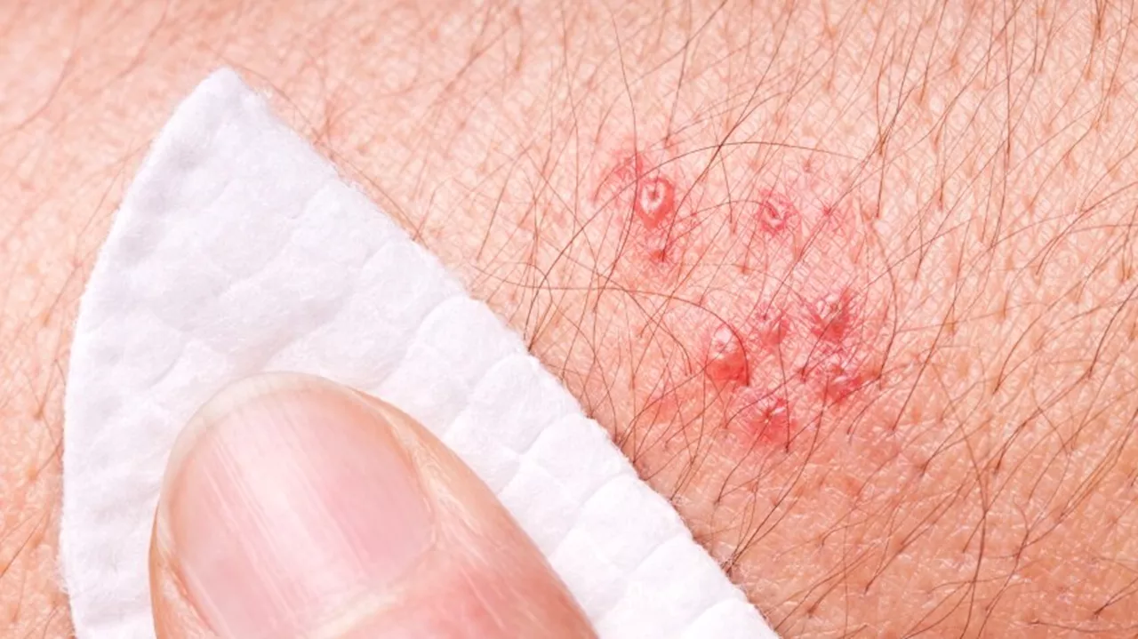 Federal government funds free shingles vaccinations for older Australians