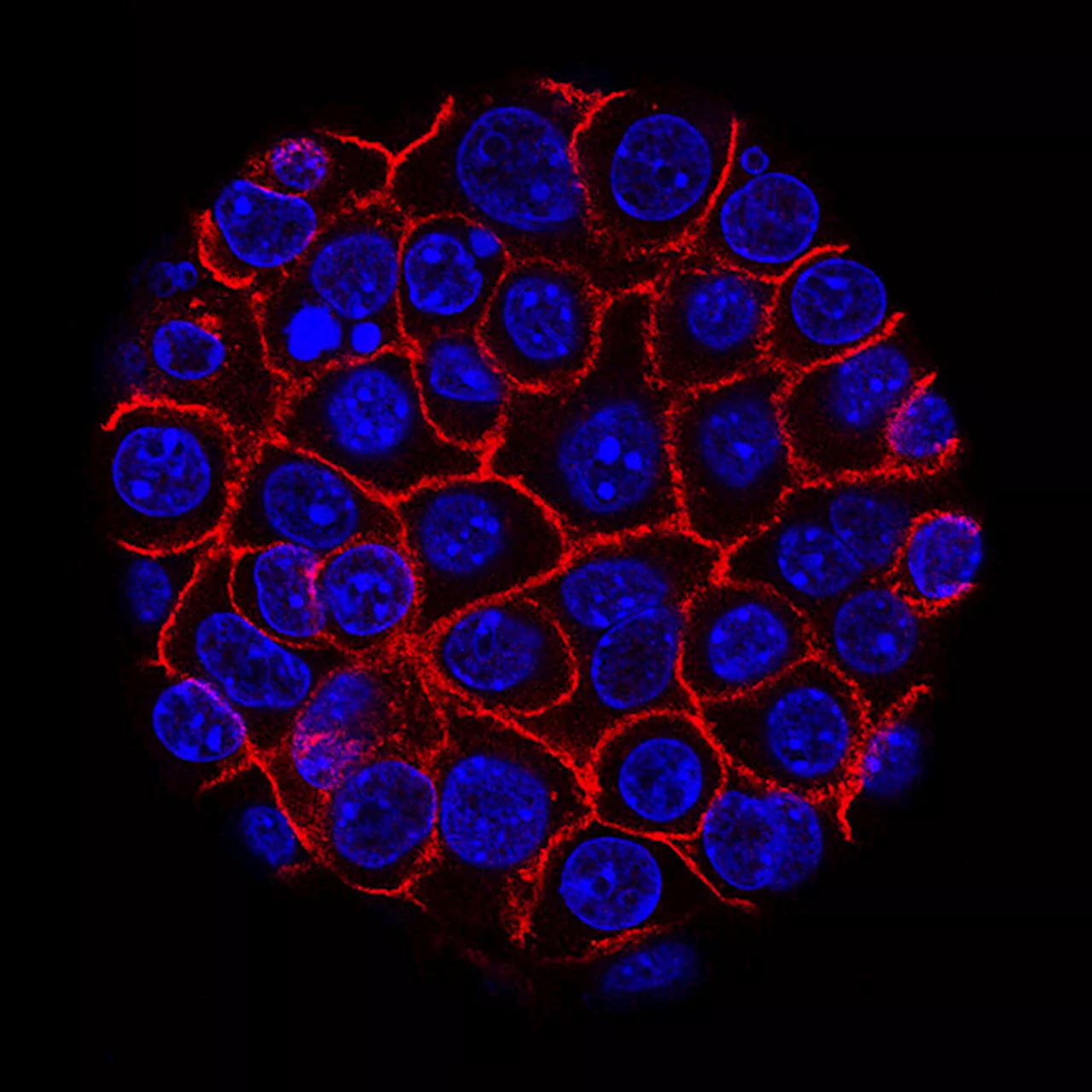 Trovato uno dei motori che fanno crescere il tumore del pancreas