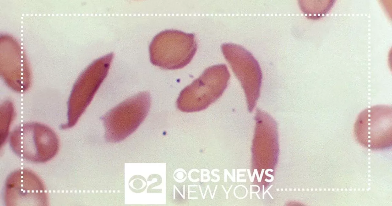 Expert joins CBS New York to discuss new sickle cell treatment