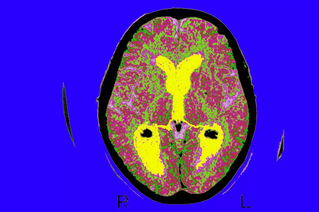 Medicare Lifts Its National Coverage Restriction On Alzheimer’s Disease PET Diagnostics