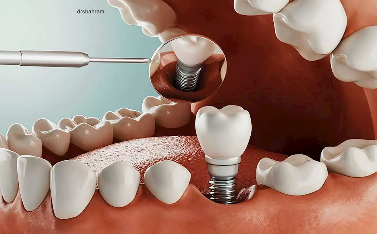 هزینه ایمپلنت دندان چقدر است و چه مزایا و معایبی دارد؟