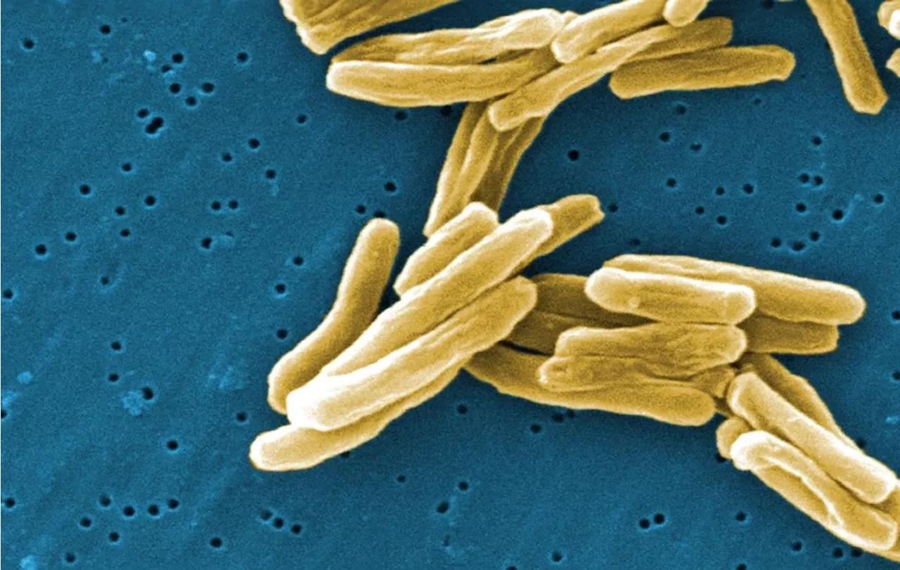 Active case of tuberculosis detected at University of Victoria