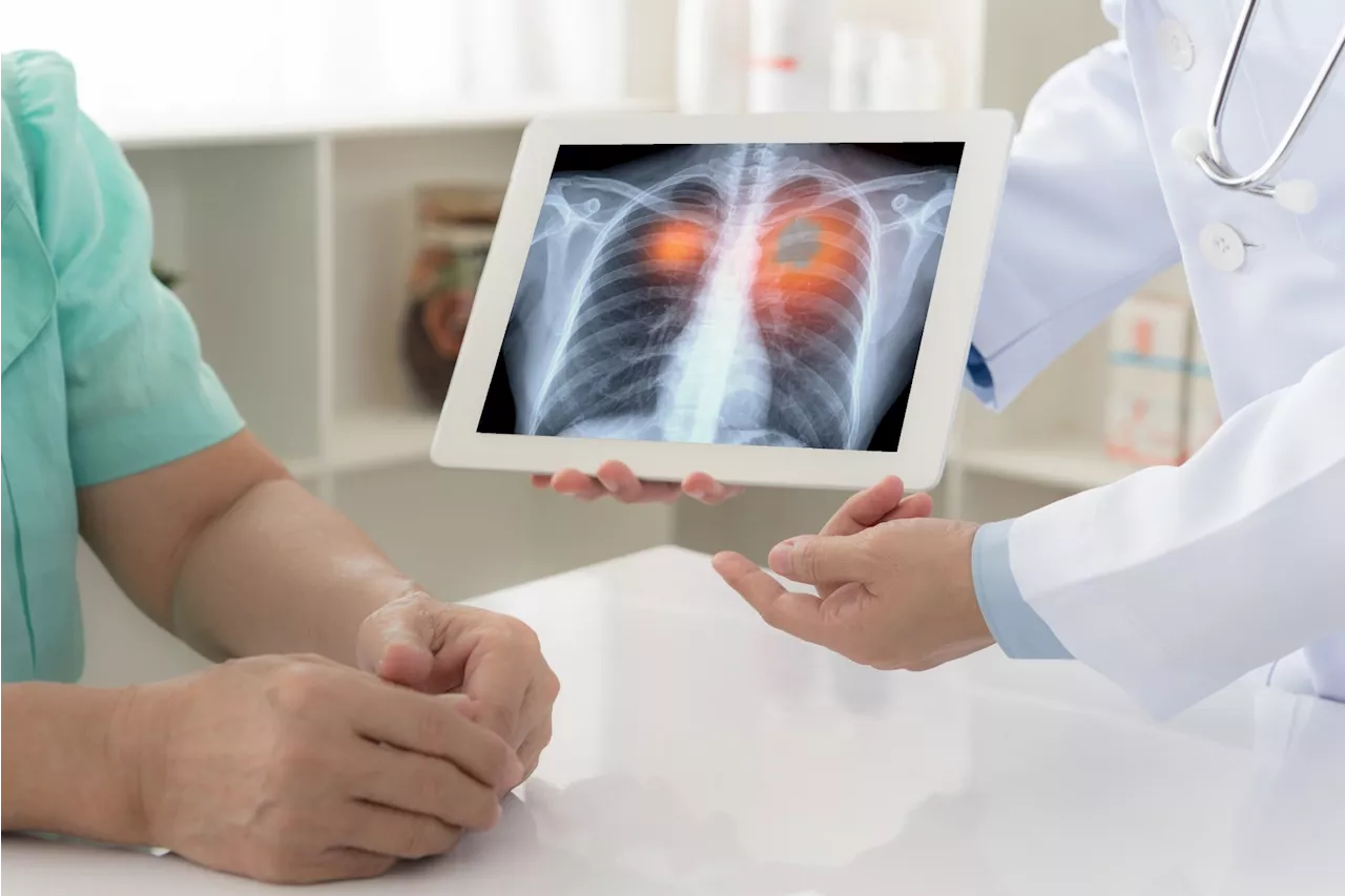 Pioneering study finds predictive biomarker in lung adenocarcinoma