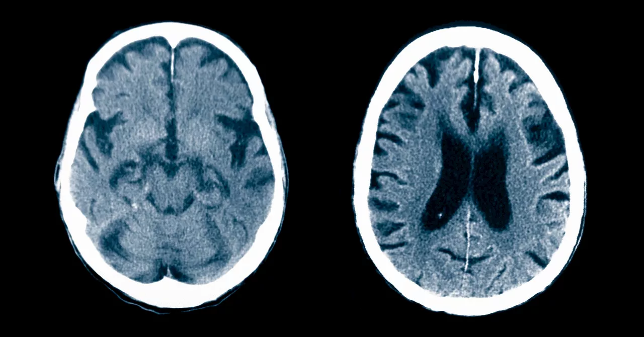 Nearly Everyone With Mild Cognitive Impairment Goes Undiagnosed