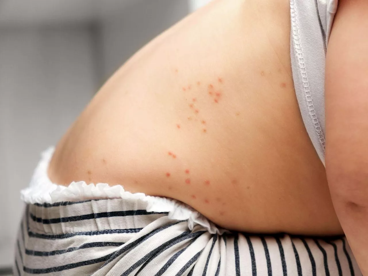 Scientists recommend chickenpox vaccine for young children