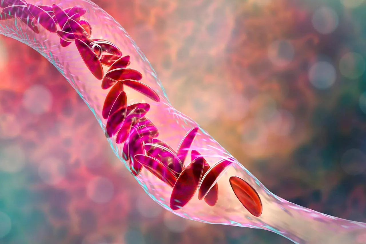 Two Sickle Cell Disease Gene Therapies May Soon Be Approved By FDA