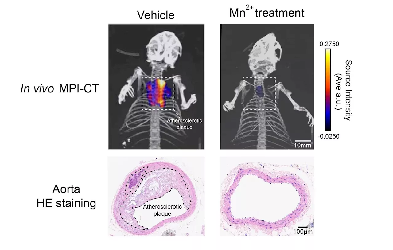 A 'manganese bullet' targeting cardiovascular disease? Research finds potential therapy for intensive lipid lowering