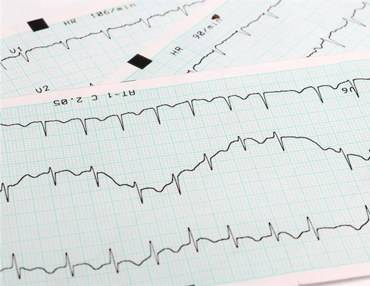 Pulsed field ablation safe and effective for women with atrial fibrillation