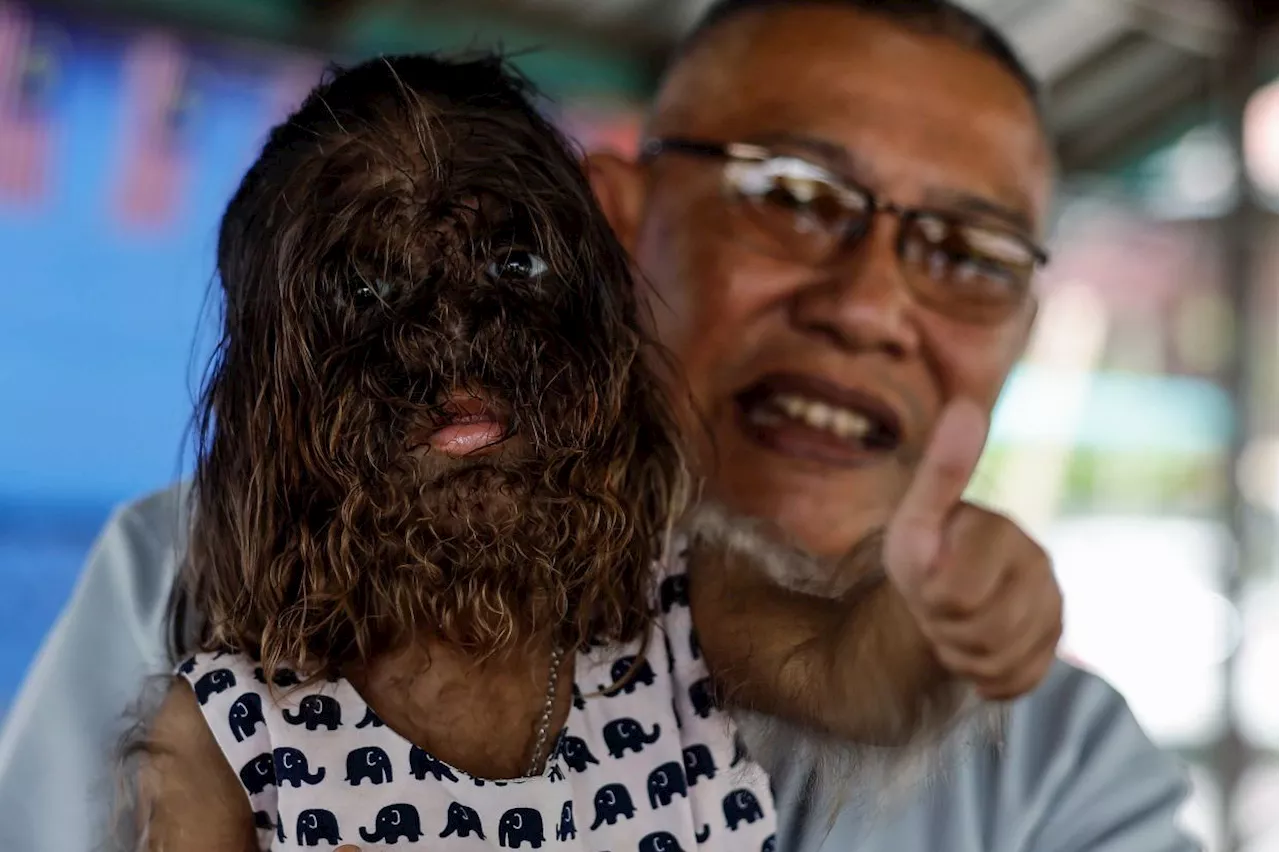 Father of child with Werewolf Syndrome cherishes King's advice