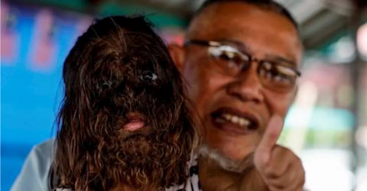 Father of child with Werewolf Syndrome cherishes King’s advice