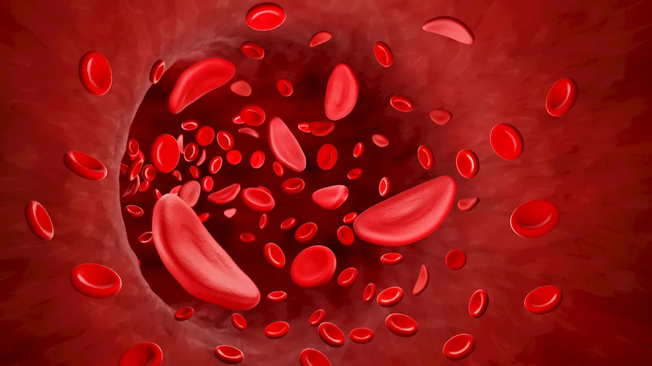 UK Authorises World's First Gene Therapy for Sickle Cell Disease