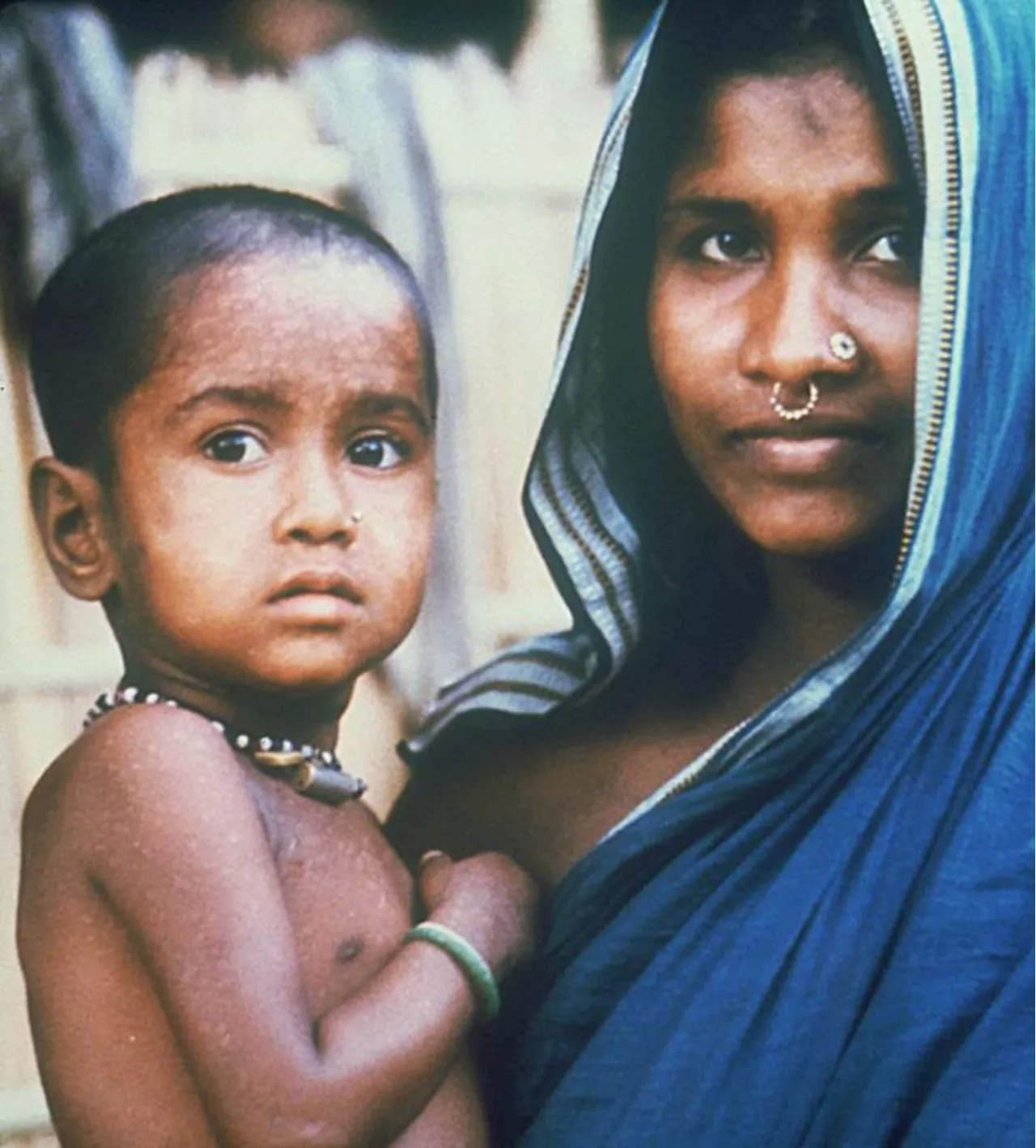 The Last Person to Contract Smallpox