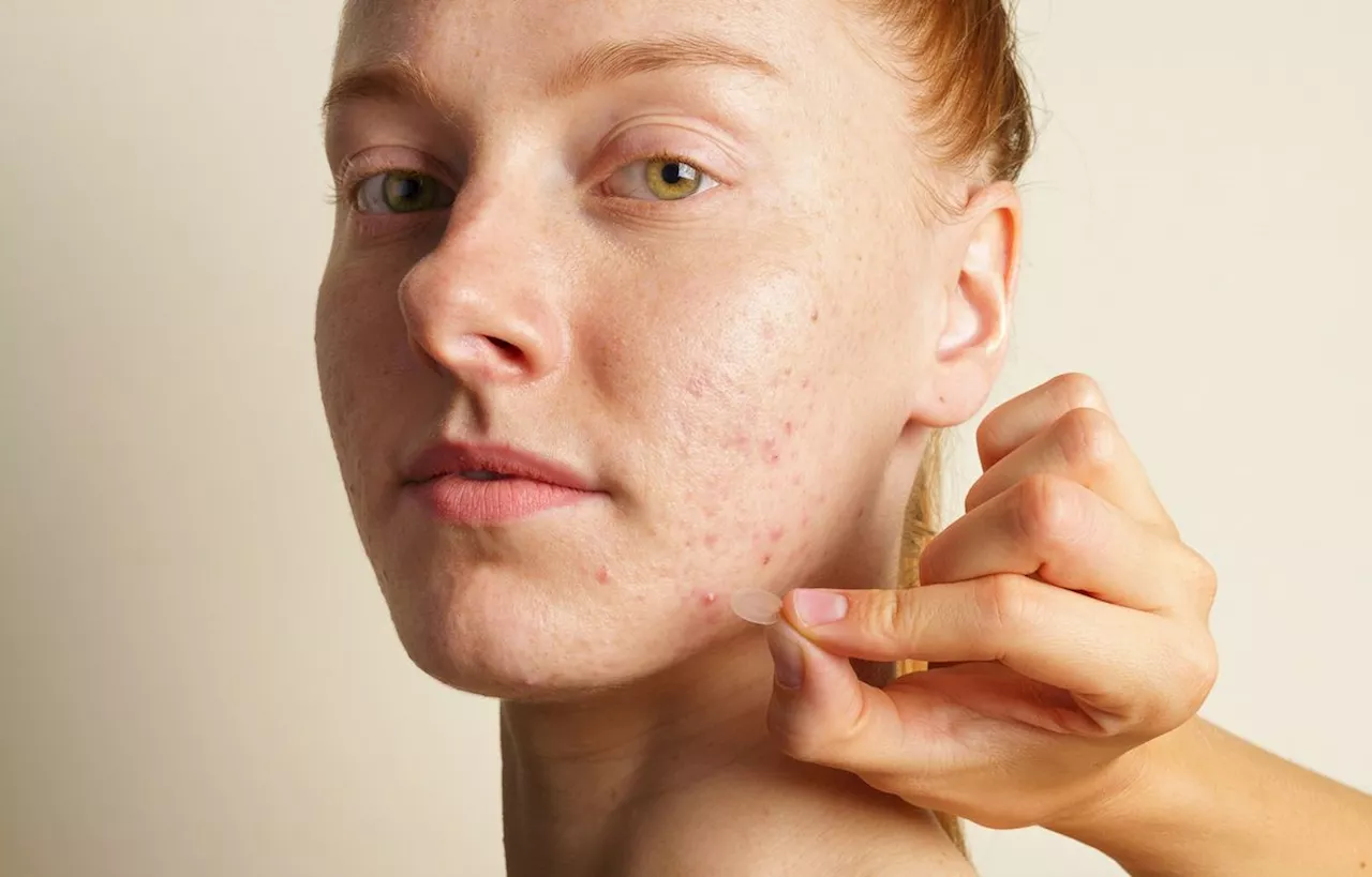 « Pimple popping » : Percer son bouton, si, si, on peut le faire, mais pas n’importe comment