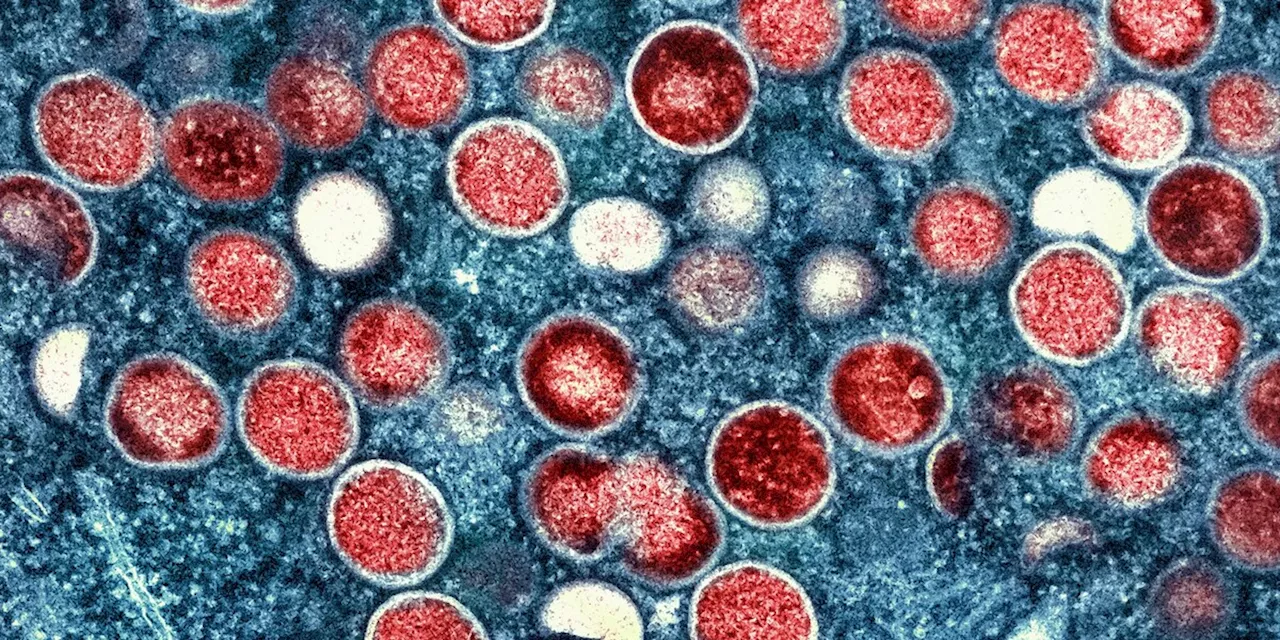 Krankheiten: Studie: Ursprung des Mpox-Ausbruchs liegt länger zurück