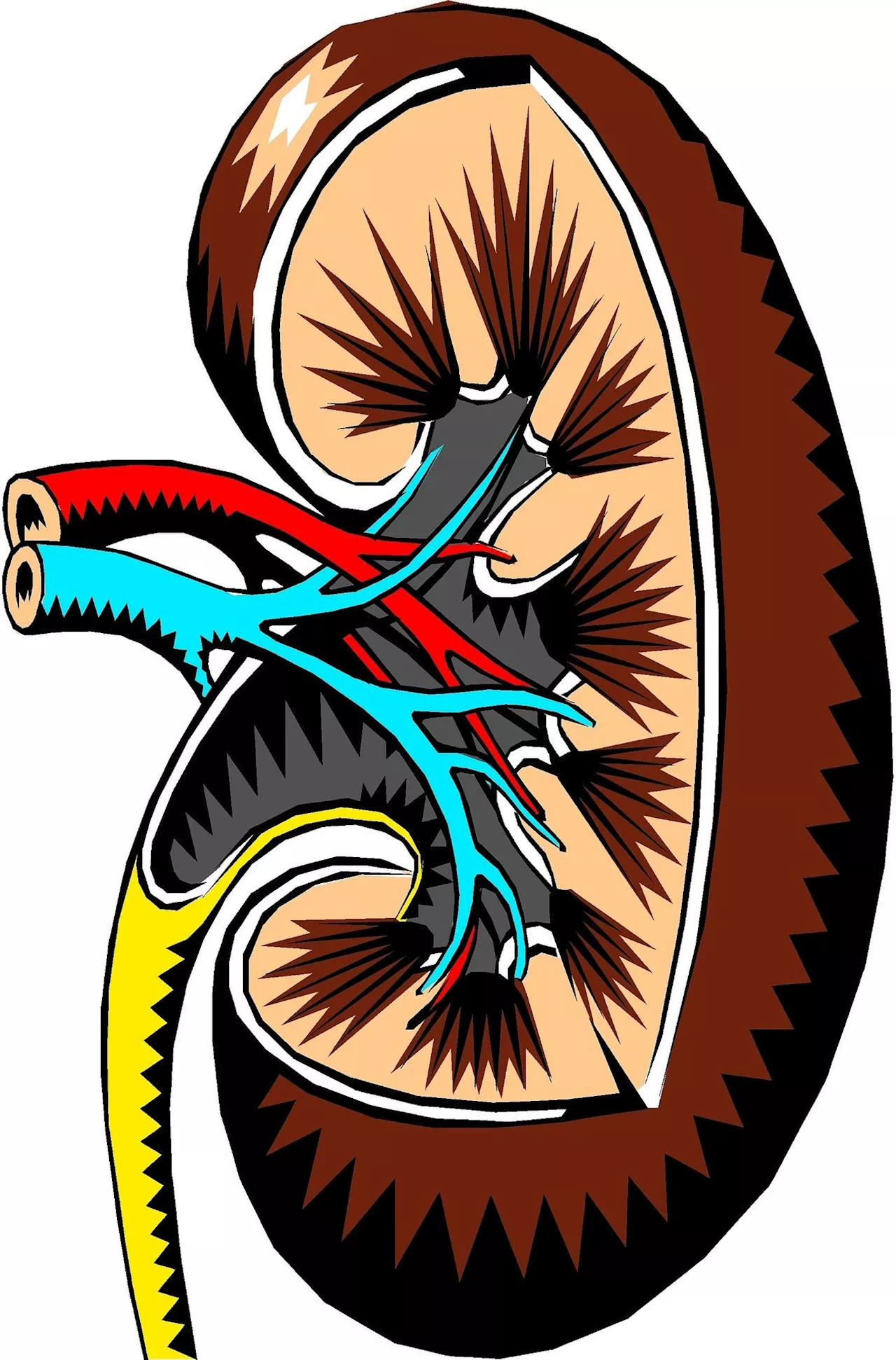 Sotagliflozin found to protect kidney and heart in patients with type 2 diabetes and chronic kidney disease