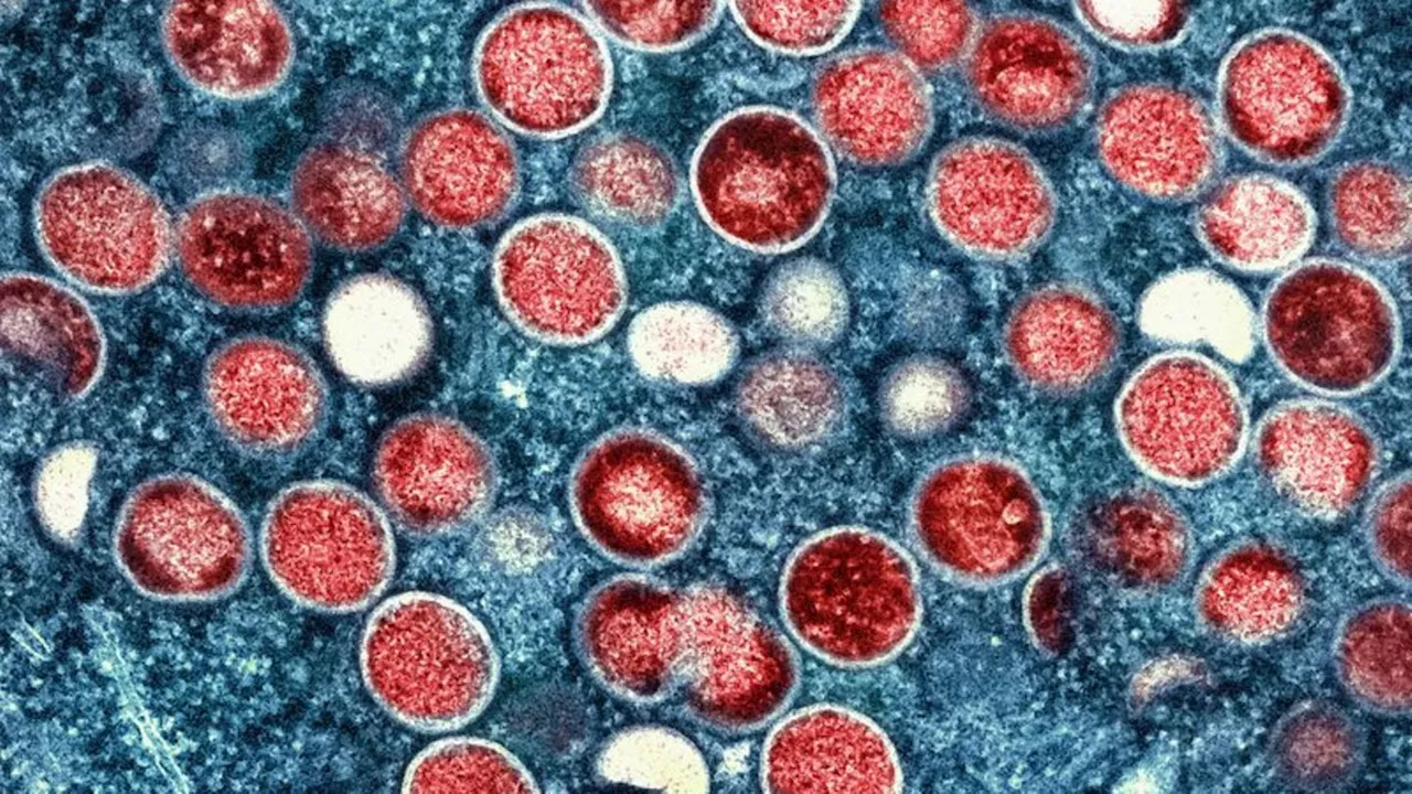 Krankheiten: Studie: Ursprung des Mpox-Ausbruchs liegt länger zurück