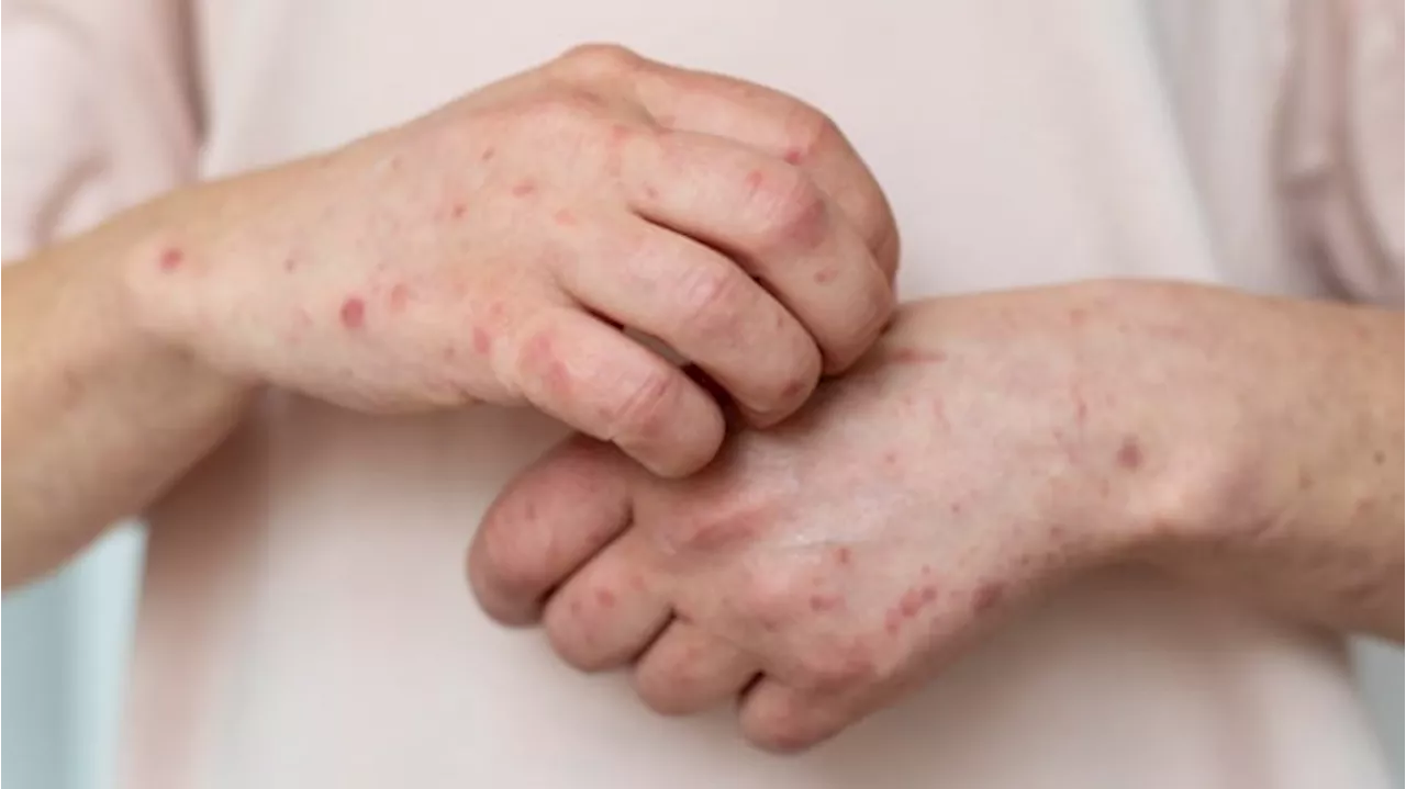 Indonesia Now Has 33 Cases of Monkeypox