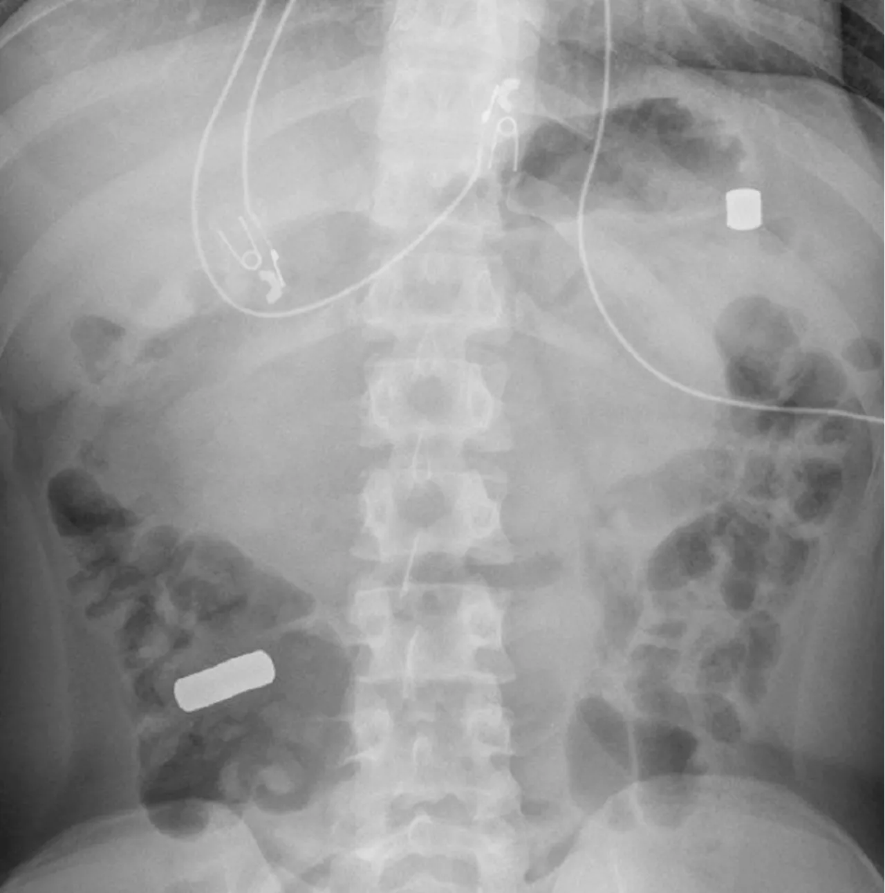 Médicos encontram 21 ímãs no intestino de adolescente que sofria com cólicas abdominais