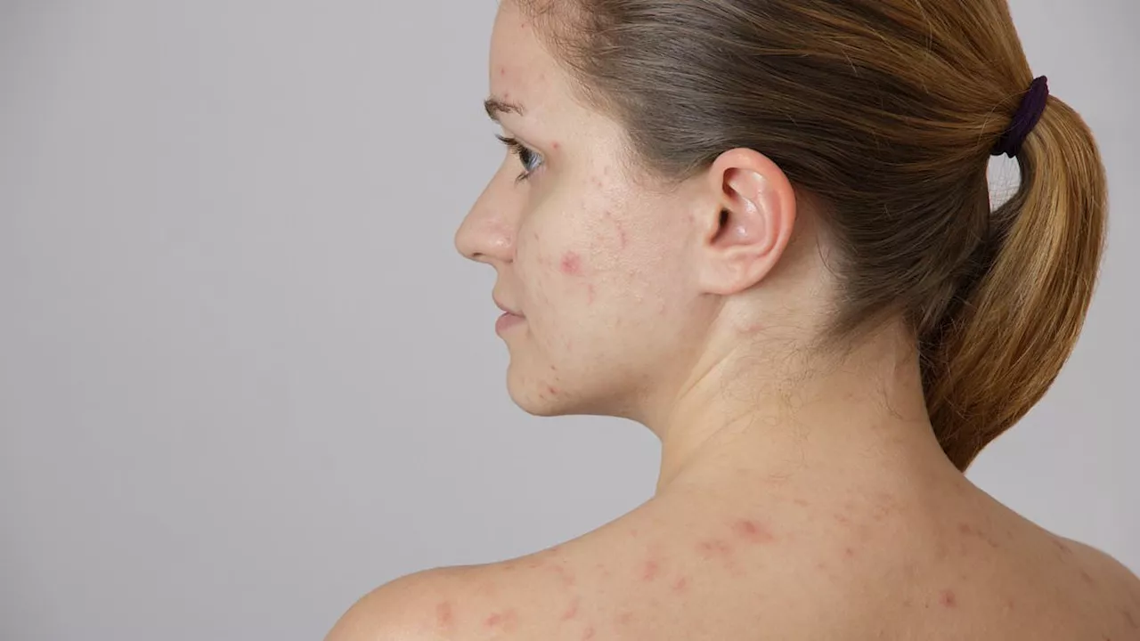 Once-a-month jab can ease agony of debilitating acne after trials showed a 50 per cent reduction in...