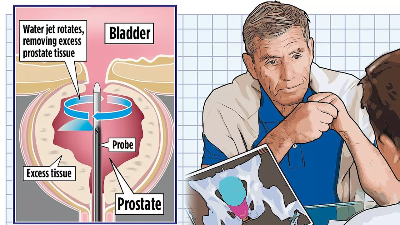 Water-jet procedure to shrink enlarged prostates will be offered to thousands of male patients as...