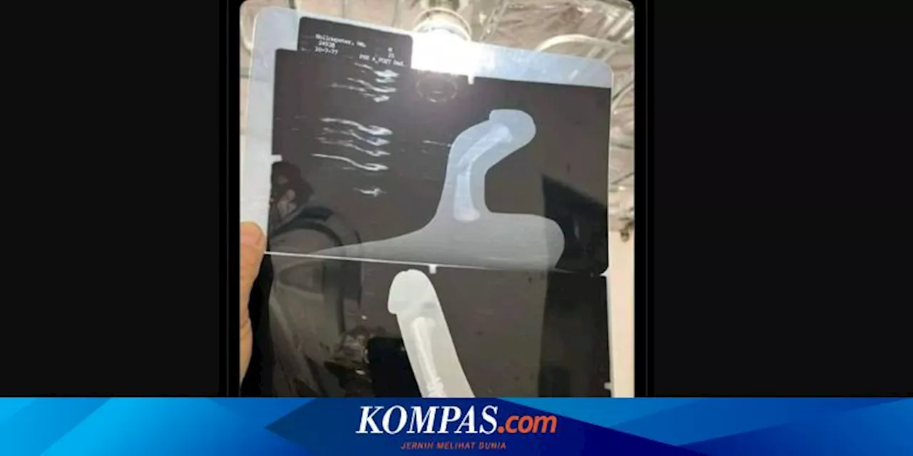 Ramai soal Foto Penis Patah, Dokter Boyke Ungkap Penyebab dan Cara Menanganinya