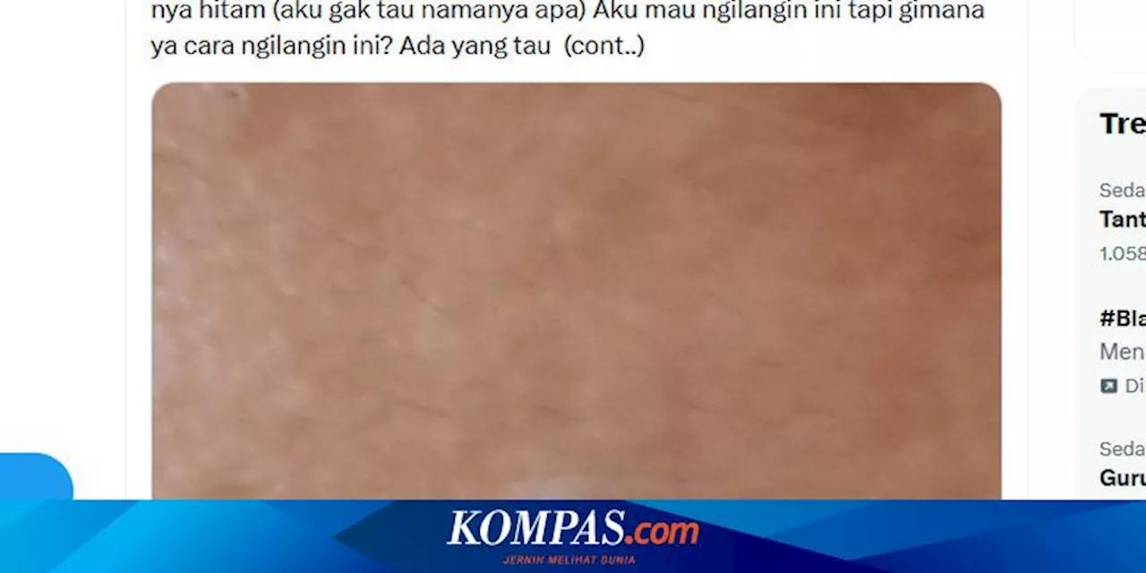 Ramai soal Benjolan Hitam di Dahi, Penyakit Apa Itu?