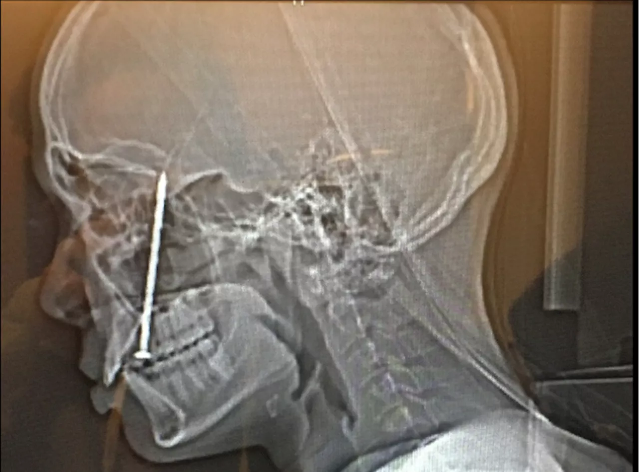 Bay Area carpenter gets nail shot through tongue into head, sues nail gun maker