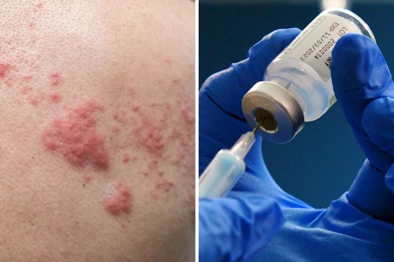 Am I eligible for the shingles vaccine and how do I get one?