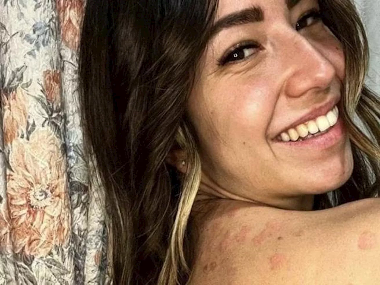 Federica Merini: «La mia psoriasi mi rende unica. Rendete le vostre imperfezioni una forza»