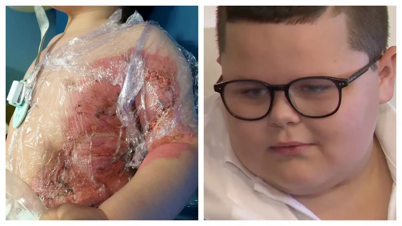 'Amazing' recovery of Cambridgeshire boy whose skin came off 'in handfuls' after coffee burns