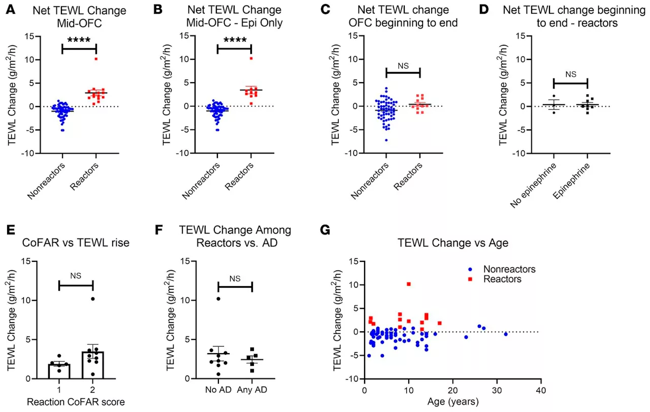 Measuring skin water loss found to predict anaphylaxis during food allergy tests