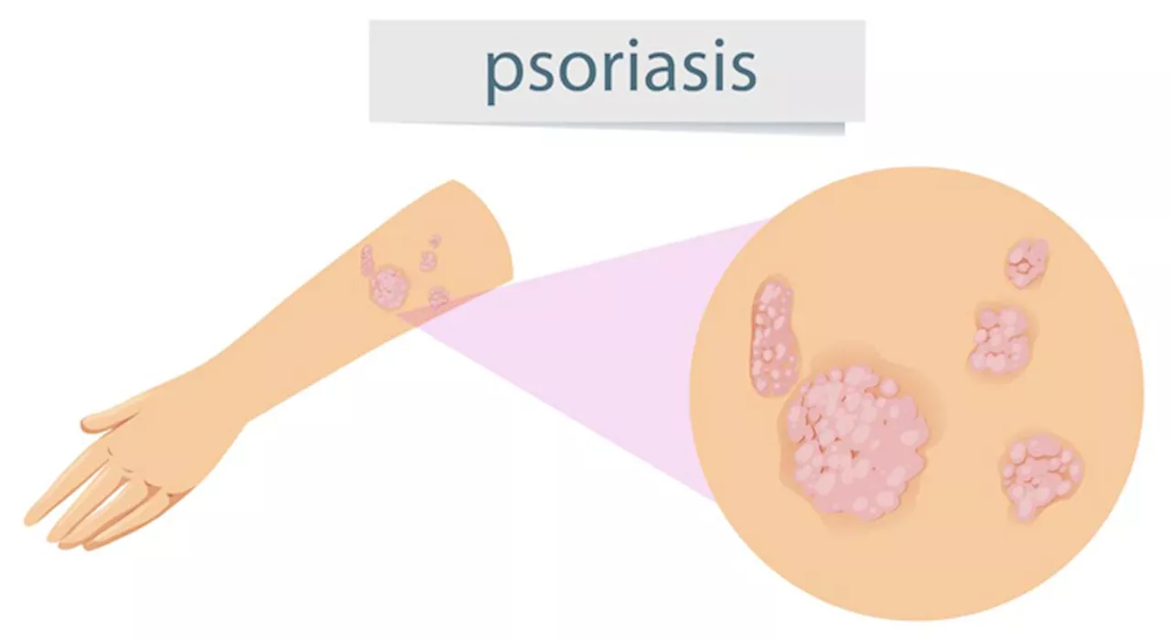 Psoriasis PHL advocates for inclusive, quality, and accessible health care