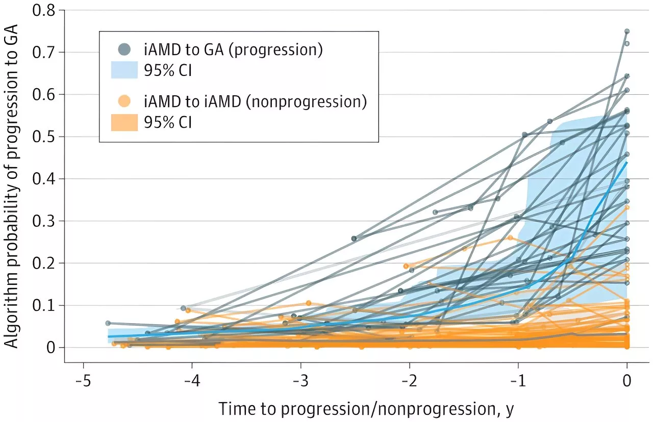 Algorithm aids in early detection of age-related eye disease