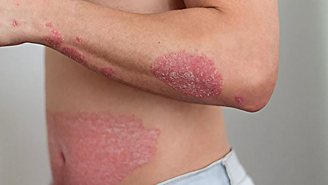 Researchers Tease Apart Multiple Biologic Failure in Psoriasis, PsA