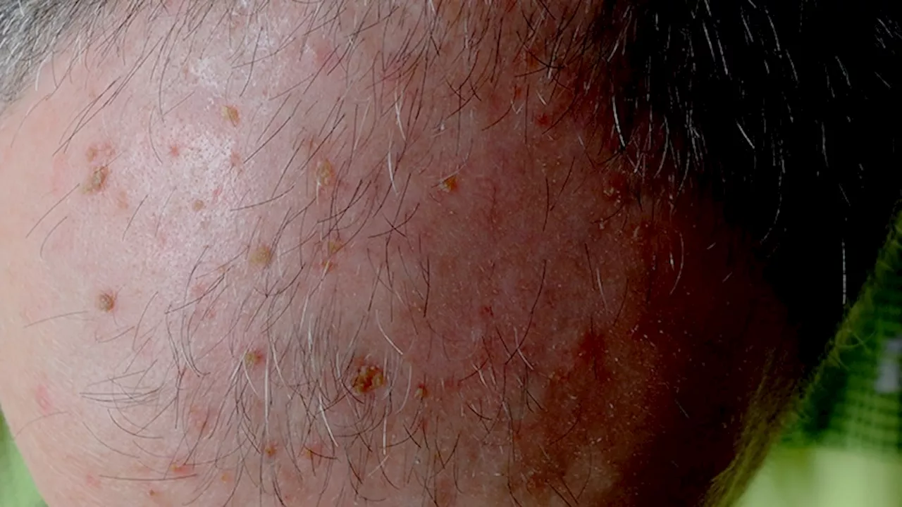 Actinic Keratoses May Predict Skin Cancers in Older Adults